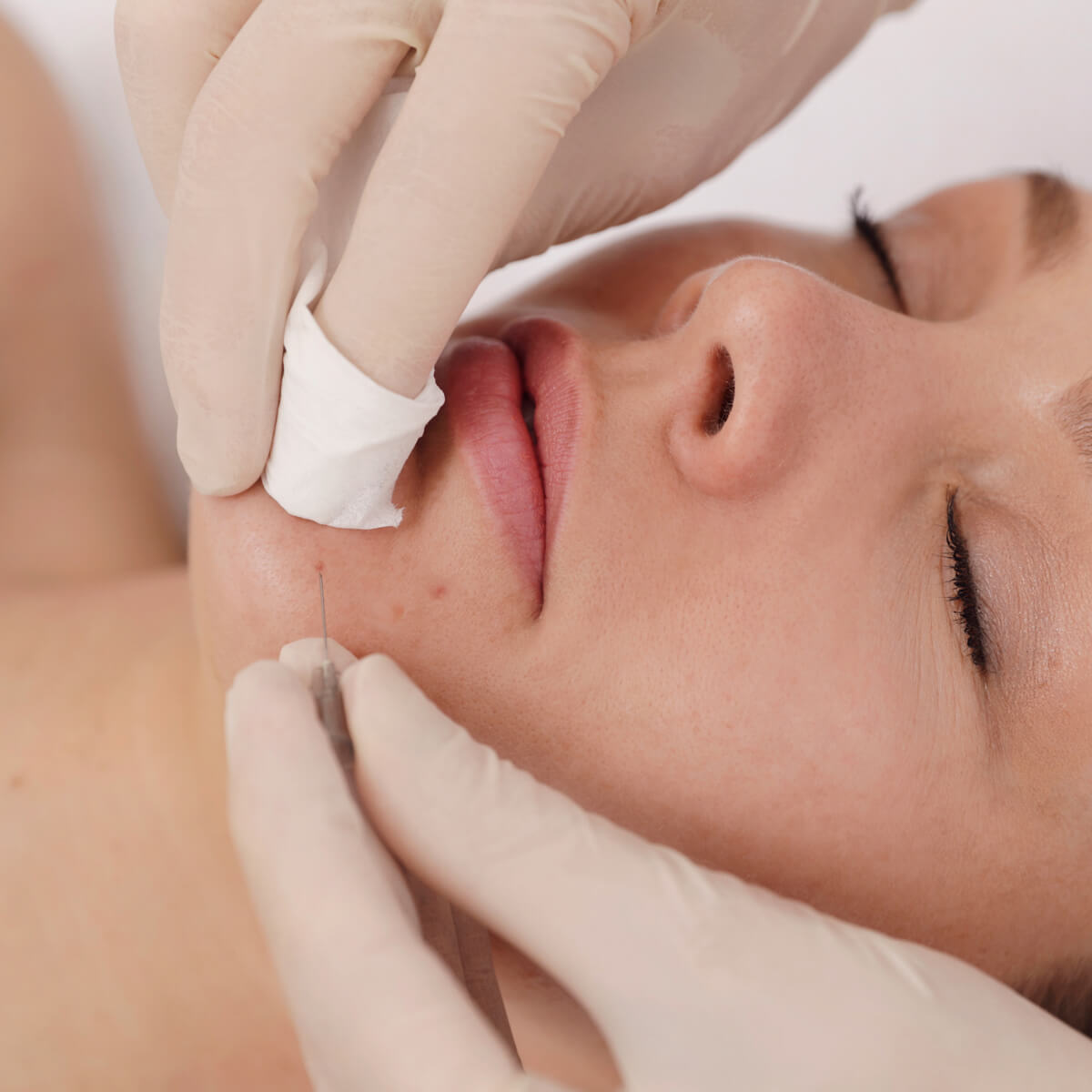Acnebehandeling - Van Schuppen Huid- en Laserkliniek Sneek Friesland