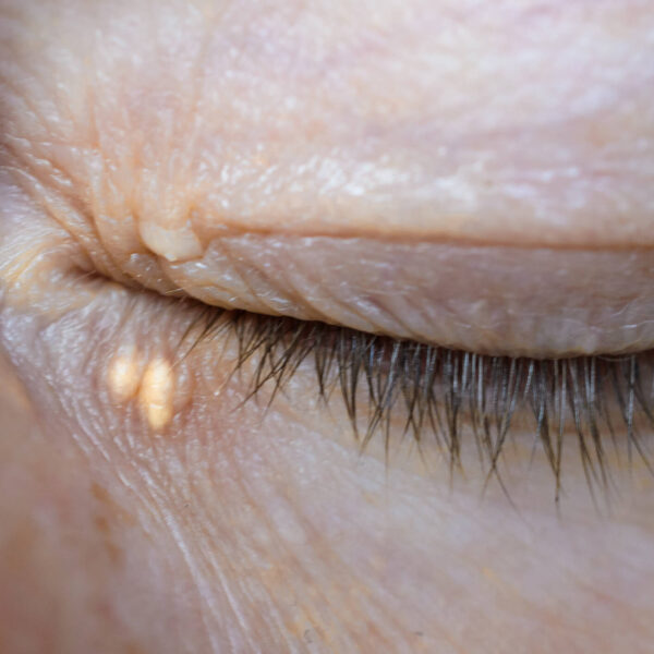 Xanthelasma palpebrarum