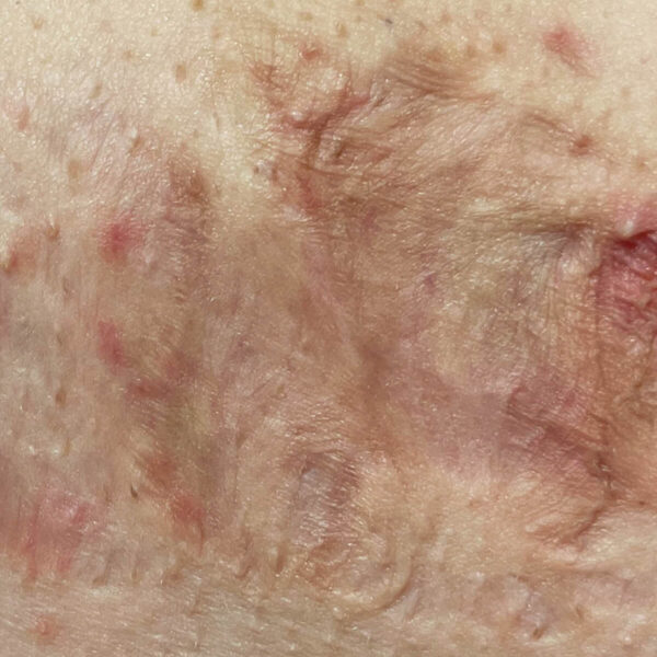 Hidradenitis suppurativa