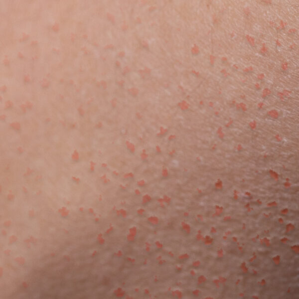 Keratosis pilaris