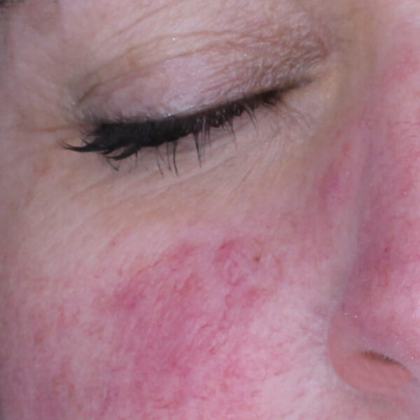 Rosacea