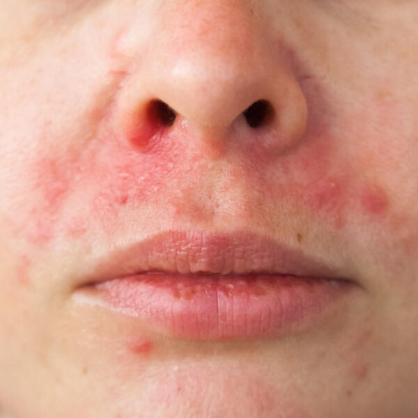 Acné Dermatitis Perioralis