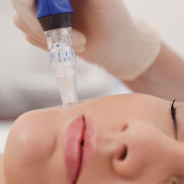 SkinPen micro-needling