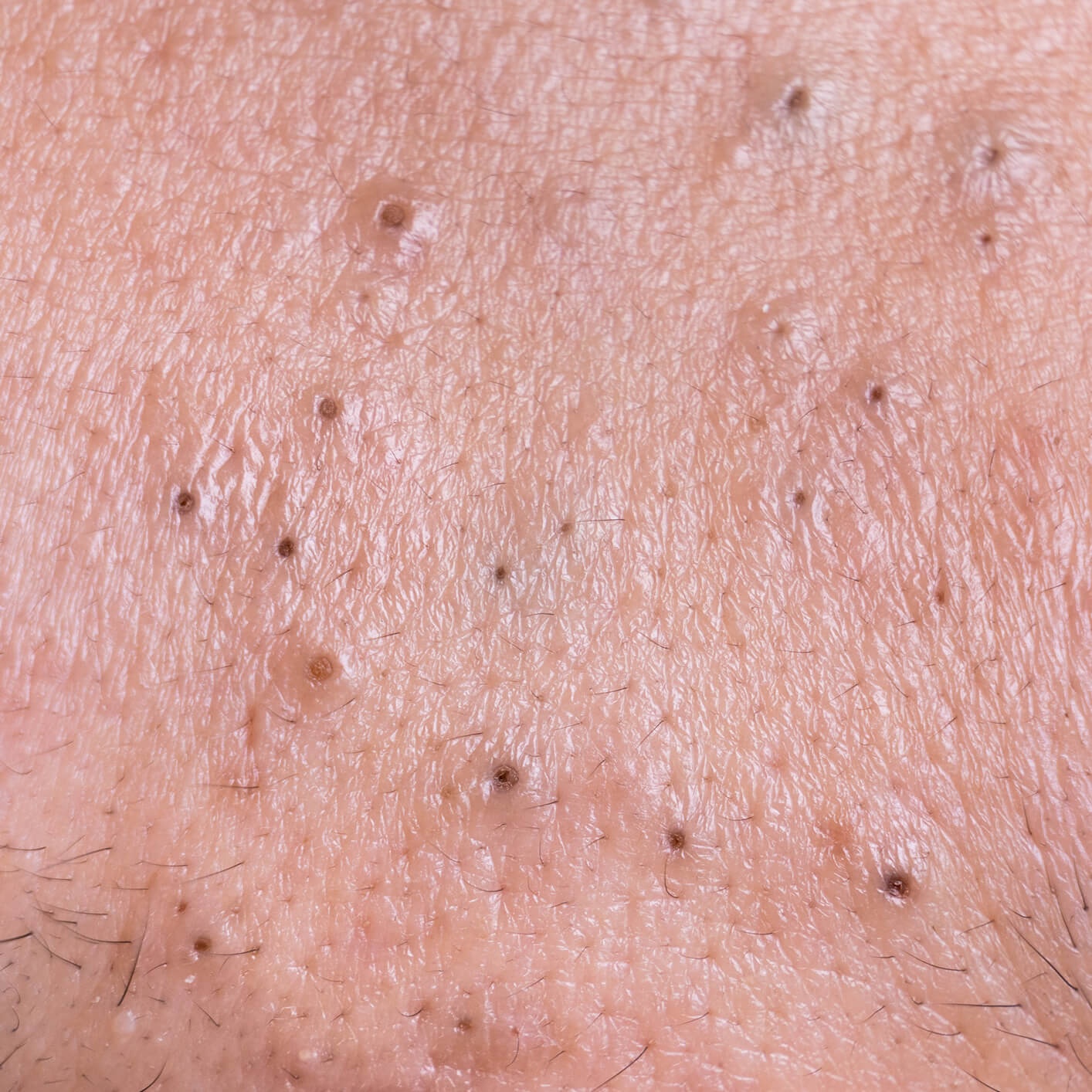 Acné Comedonica Van Schuppen Huidtherapie en Laserkliniek Sneek